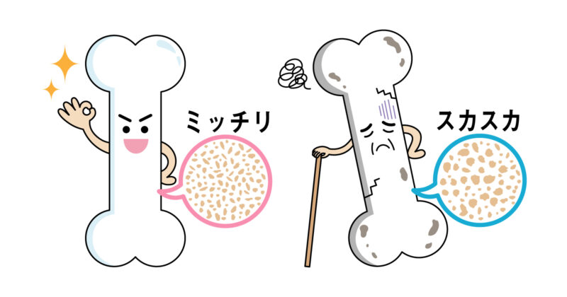 骨粗鬆症とは？その重要性と骨密度検査について
