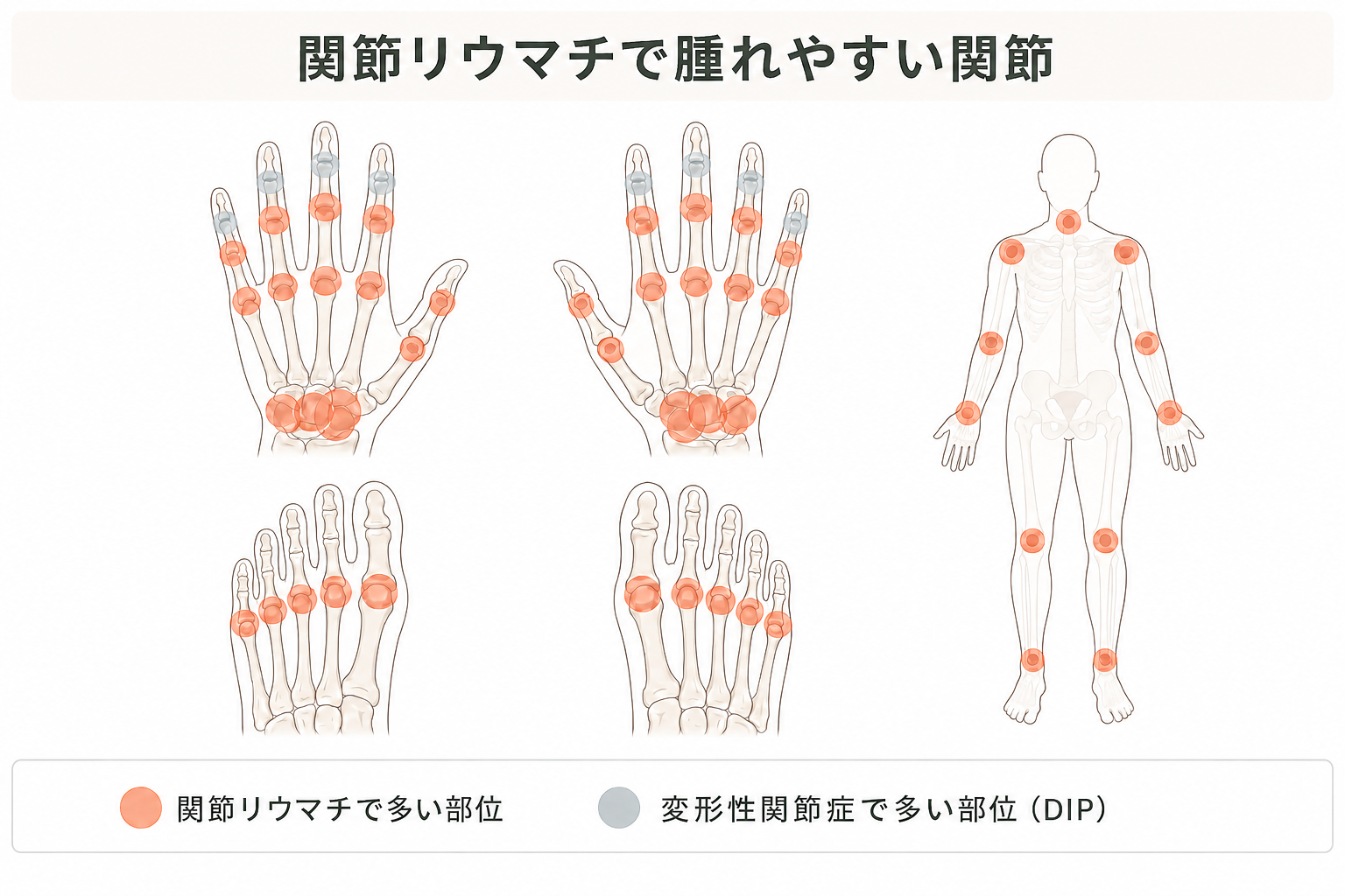 関節リウマチで腫れやすい関節
