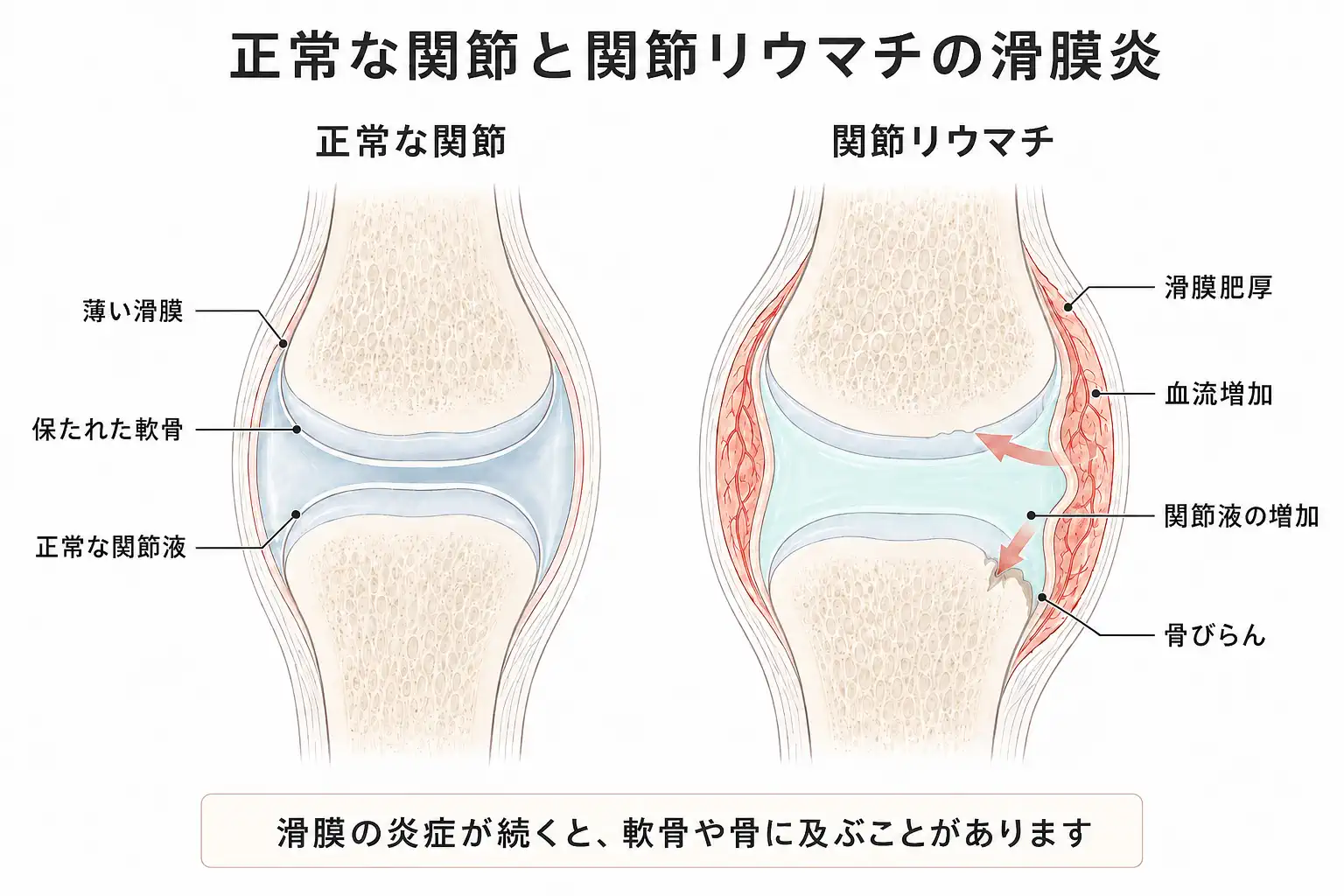 関節リウマチにて炎症を起こしている関節